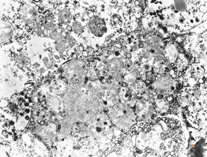  F,69y. | urinary bladder - malakoplakia